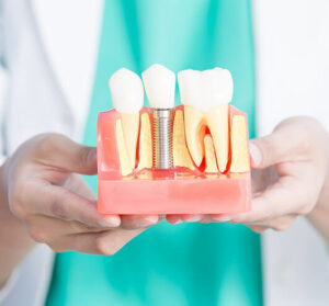 dental implant services