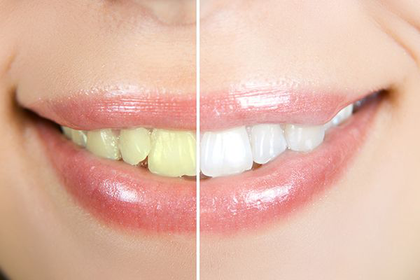 How to Make Teeth White Naturally from Yellow?